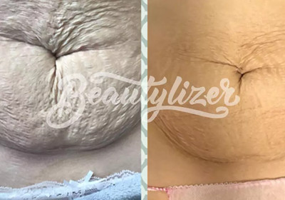 Beautylizer фото до и после процедуры