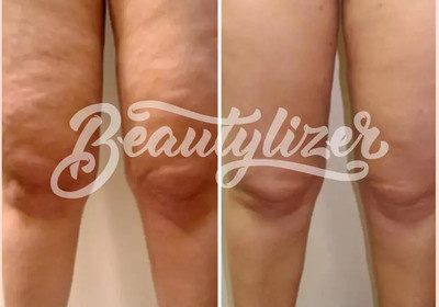 Beautylizer фото до и после процедуры